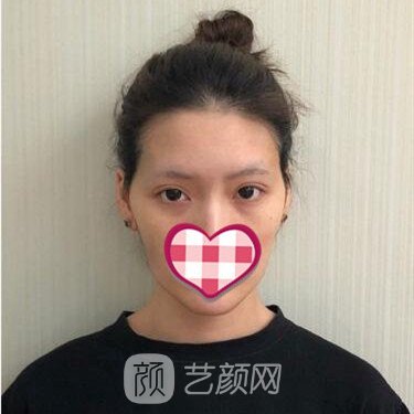 重慶鵬愛李晨耕自體脂肪面部填充一個月案例分享~